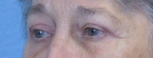 Blepharoplasty