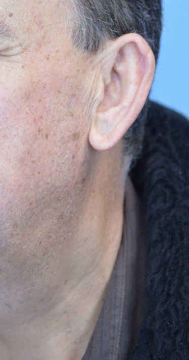 Fractional CO2 Laser Case 1745 After Photo Fractional CO2 Laser