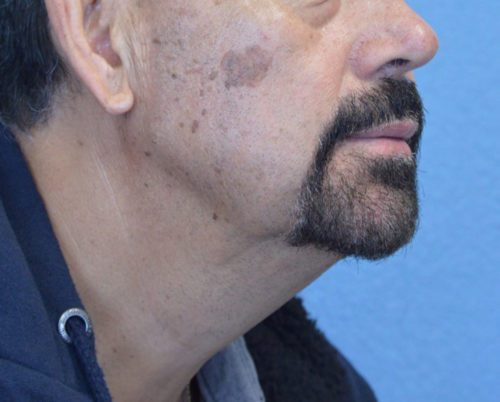 Fractional CO2 Laser Case 1745 Before Photo Fractional CO2 Laser