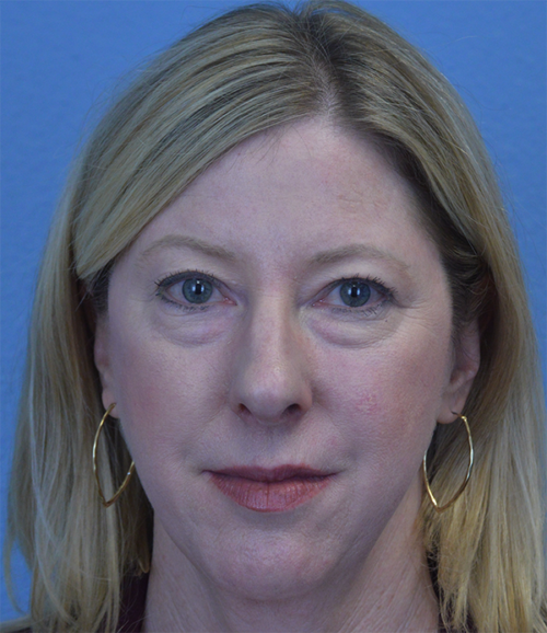 Blepharoplasty Case 1755 Before Photo Blepharoplasty
