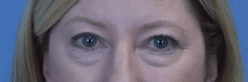 Blepharoplasty