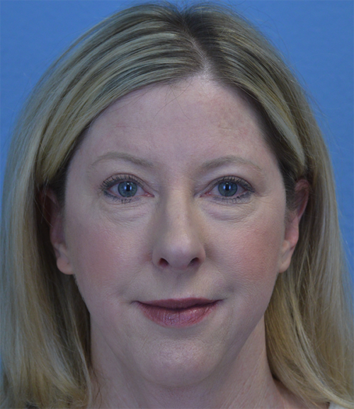 Blepharoplasty Case 1755 After Photo Blepharoplasty