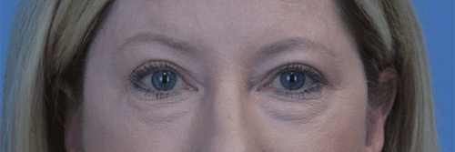 Blepharoplasty