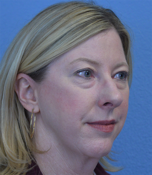 Blepharoplasty Case 1755 Before Photo Blepharoplasty
