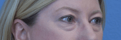 Blepharoplasty