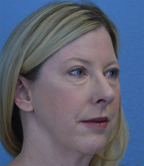 Blepharoplasty Case 1755 After Photo Blepharoplasty