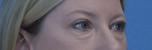 Blepharoplasty