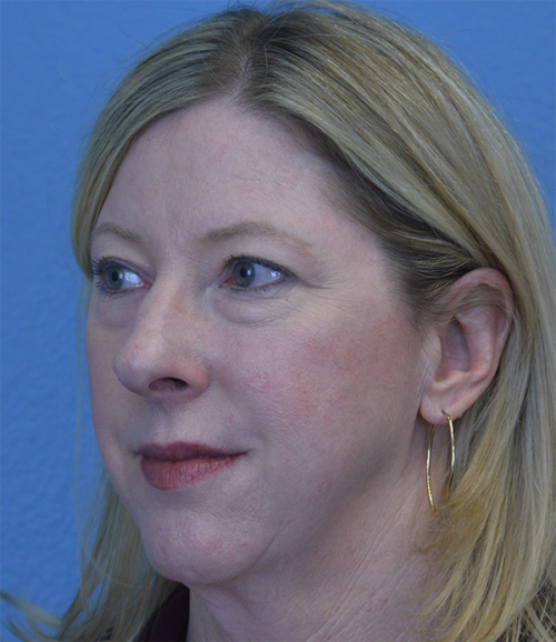 Blepharoplasty Case 1755 Before Photo Blepharoplasty