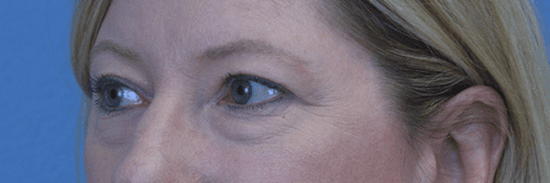 Blepharoplasty