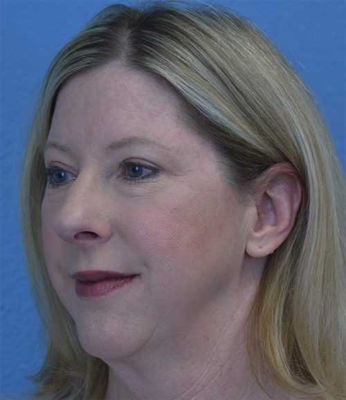Blepharoplasty Case 1755 After Photo Blepharoplasty