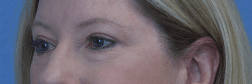 Blepharoplasty