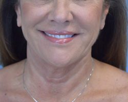 Face and Neck Lift