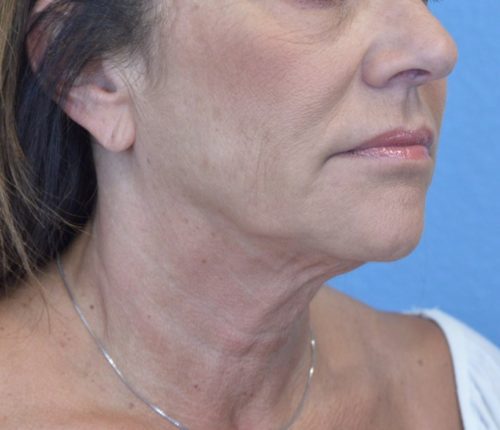 Face and Neck Lift