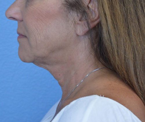 Face and Neck Lift