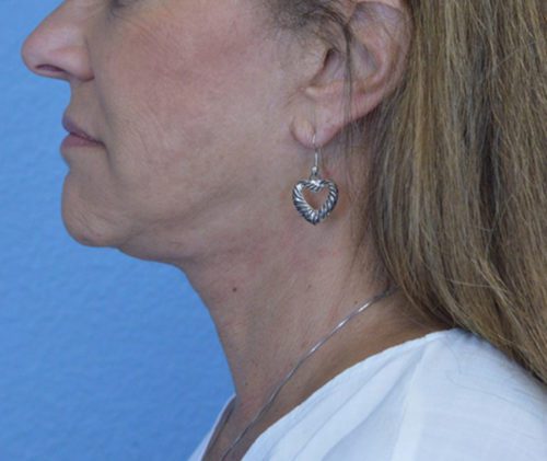 Face and Neck Lift