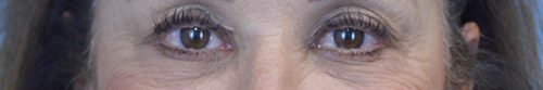 Blepharoplasty