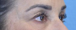 Blepharoplasty