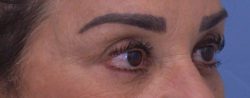 Blepharoplasty