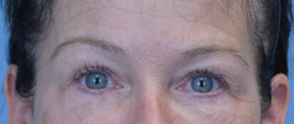 Blepharoplasty