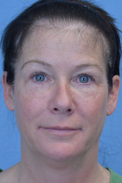 Blepharoplasty Case 2550 Before Photo Blepharoplasty