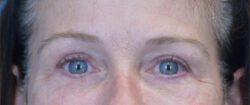 Blepharoplasty