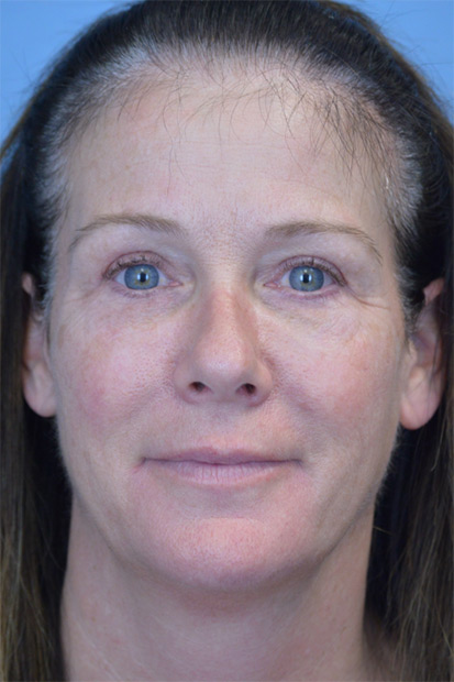 Blepharoplasty Case 2550 After Photo Blepharoplasty