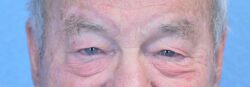 Blepharoplasty