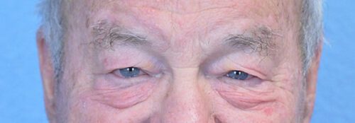 Blepharoplasty