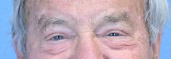 Blepharoplasty