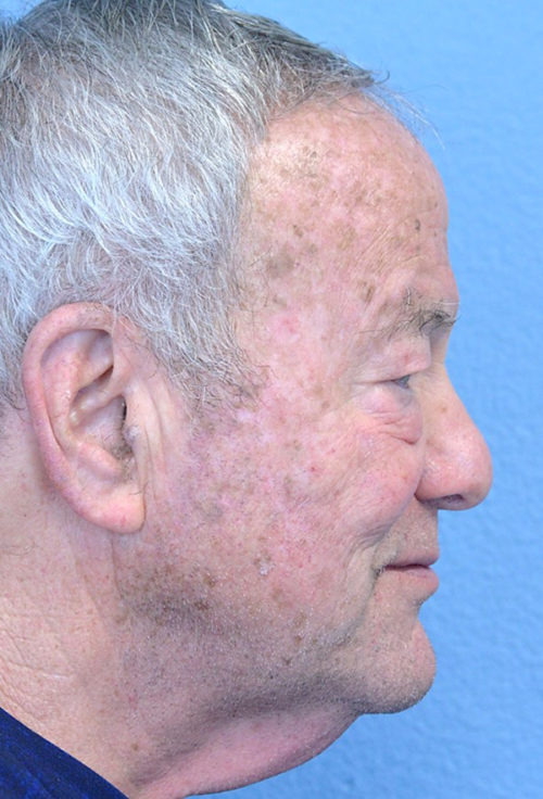 Blepharoplasty Case 2723 Before Photo Blepharoplasty