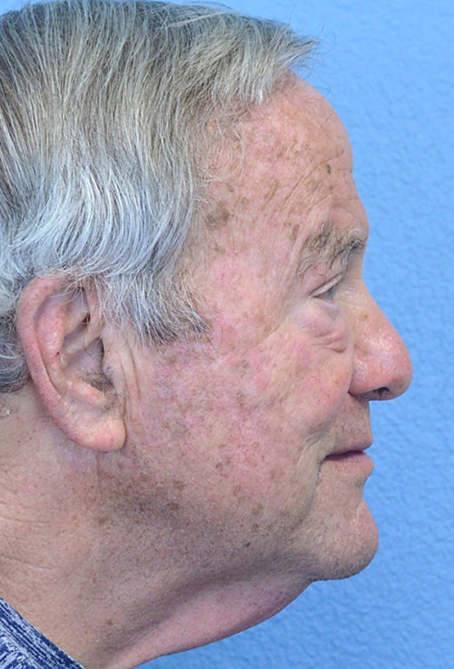Blepharoplasty Case 2723 After Photo Blepharoplasty