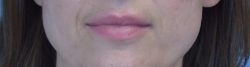 Lip Augmentation