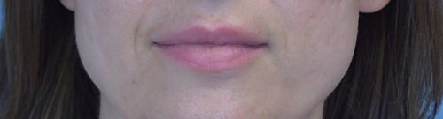 Lip Augmentation