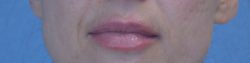 Lip Augmentation