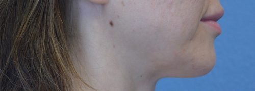 Lip Augmentation