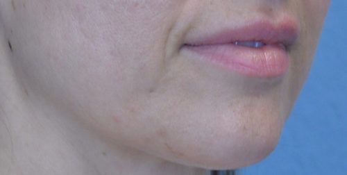 Lip Augmentation