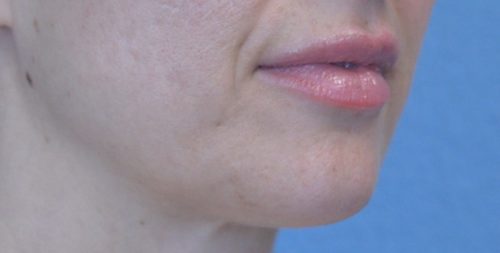 Lip Augmentation