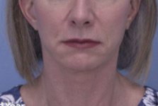 Facelift & Neck Lift