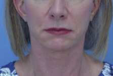 Facelift & Neck Lift