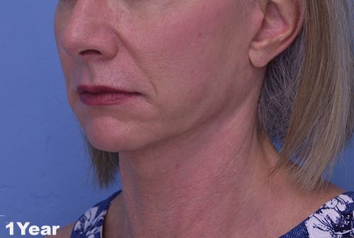 Face and Neck Lift Case 3002 After Photo Face and Neck Lift