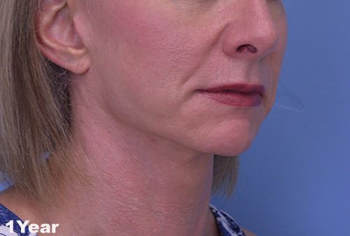 Face and Neck Lift Case 3002 After Photo Face and Neck Lift