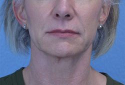 Facelift & Neck Lift