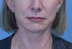 Facelift & Neck Lift