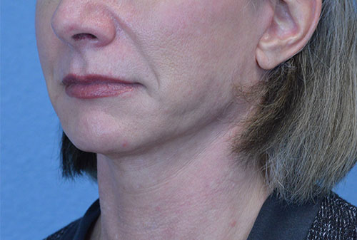 Face and Neck Lift Case 3002 After Photo Face and Neck Lift
