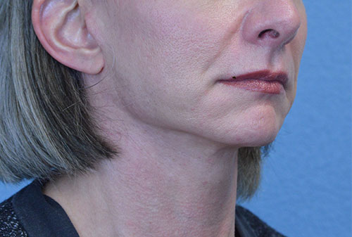 Face and Neck Lift Case 3002 After Photo Face and Neck Lift