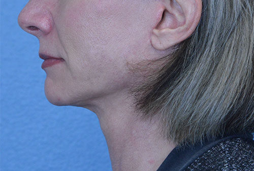 Face and Neck Lift Case 3002 After Photo Face and Neck Lift
