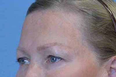 Blepharoplasty