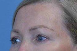 Blepharoplasty