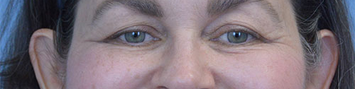 Blepharoplasty