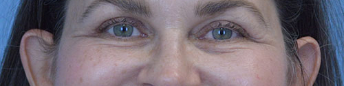 Blepharoplasty